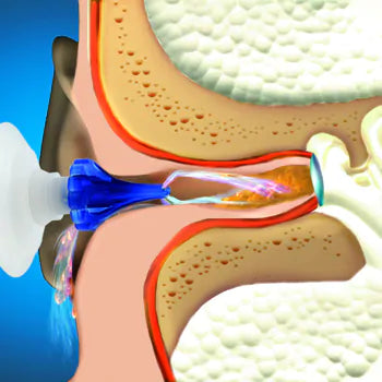 Mack's Pro Rinse to remove Earwax